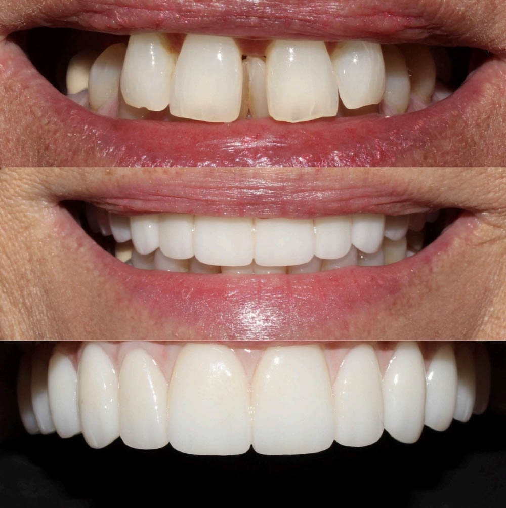 Jeansonne   Spillers Dentistry | Sleep Apnea, Veneers and Ceramic Crowns