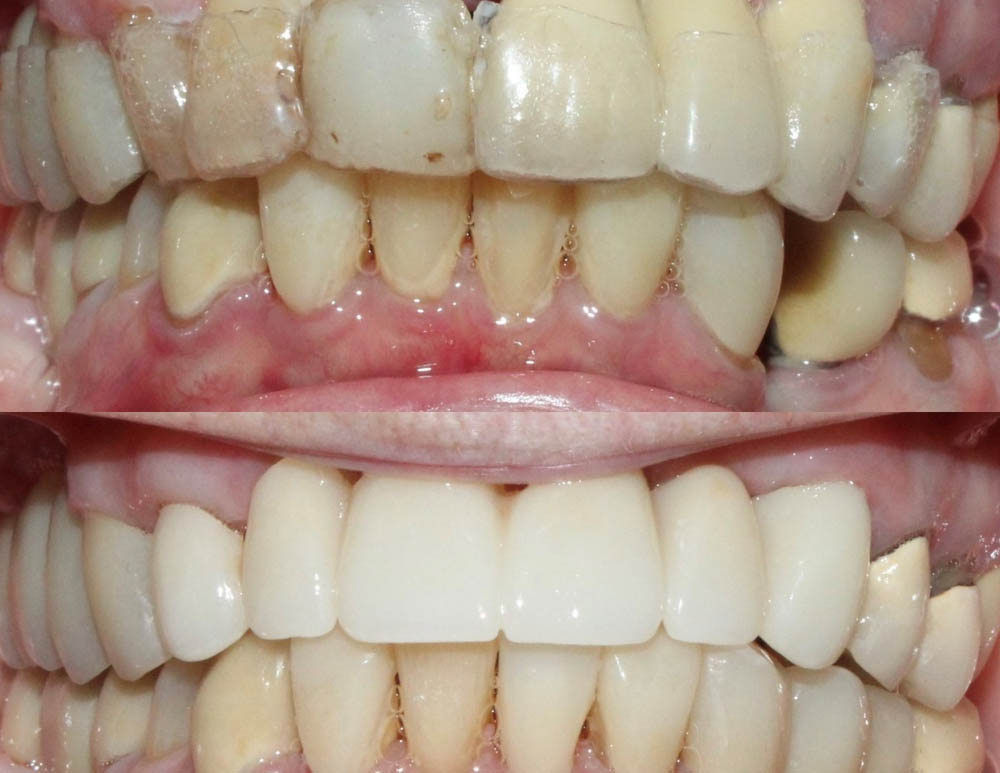 Jeansonne   Spillers Dentistry | Teeth Whitening, Dental Cleanings and Implant Restorations